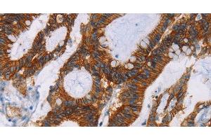 Immunohistochemistry of paraffin-embedded Human colon cancer using GPA33 Polyclonal Antibody at dilution of 1:30 (GPA33 抗体)