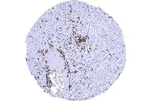 Numerous MPO positive intravascular and stromal granulocytes are seen in a squamous cell carcinoma of the oral cavity (Myeloperoxidase 抗体)