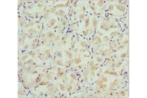 Immunohistochemistry of paraffin-embedded human gastric cancer using ABIN7146127 at dilution of 1:100 (CXCL14 抗体  (AA 35-111))