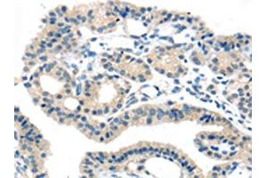 The image on the left is immunohistochemistry of paraffin-embedded Human thyroid cancer tissue using ABIN7192395(SLC16A11 Antibody) at dilution 1/25, on the right is treated with synthetic peptide.