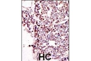 Formalin-fixed and paraffin-embedded human cancer tissue reacted with the primary antibody, which was peroxidase-conjugated to the secondary antibody, followed by DAB staining. (TYRO3 抗体  (C-Term))