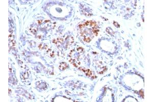 Formalin-fixed, paraffin-embedded human Breast Carcinoma stained with GATA-3 Mouse Monoclonal Antibody (GATA3/2442). (GATA3 抗体  (AA 357-436))