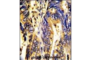 Formalin-fixed and paraffin-embedded human colon carcinoma with AXL Antibody, which was peroxidase-conjugated to the secondary antibody, followed by DAB staining. (AXL 抗体)