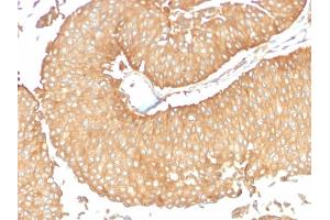 Formalin-fixed, paraffin-embedded human Ovarian Carcinoma stained with Calcineurin A Mouse Monoclonal Antibody (CALNA/2353). (PPP3CA 抗体)
