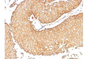 Formalin-fixed, paraffin-embedded human Ovarian Carcinoma stained with Calcineurin A Mouse Monoclonal Antibody (CALNA/2353). (PPP3CA 抗体)