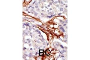 Formalin-fixed and paraffin-embedded human cancer tissue reacted with the primary antibody, which was peroxidase-conjugated to the secondary antibody, followed by AEC staining. (YES1 抗体  (N-Term))