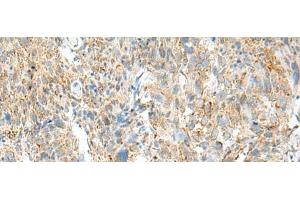 Immunohistochemistry of paraffin-embedded Human cervical cancer tissue using MCCC1 Polyclonal Antibody at dilution of 1:45(x200) (MCCC1 抗体)