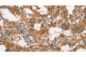 Immunohistochemistry of paraffin-embedded Human thyroid cancer using CLTC Polyclonal Antibody at dilution of 1:60 (Clathrin Heavy Chain (CLTC) 抗体)
