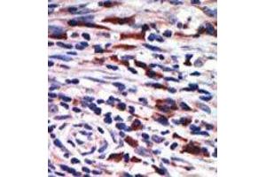 Formalin-fixed and paraffin-embedded human cancer tissue reacted with the primary antibody, which was peroxidase-conjugated to the secondary antibody, followed by AEC staining. (PKC eta 抗体  (N-Term))