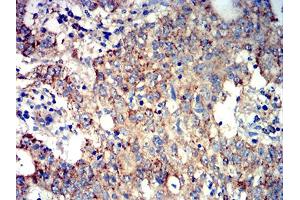 Immunohistochemical analysis of paraffin-embedded stomach cancer tissues using ATG3 mouse mAb with DAB staining.