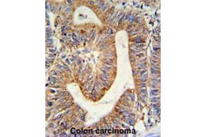 RPL17 Antibody (C-term) IHC analysis in formalin fixed and paraffin embedded colon carcinoma followed by peroxidase conjugation of the secondary antibody and DAB staining. (RPL17 抗体  (C-Term))