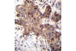 Immunohistochemistry analysis in formalin fixed and paraffin embedded human breast carcinoma reacted with GDF9 Antibody (N-term) followed by peroxidase conjugation of the secondary antibody and DAB staining. (GDF9 抗体  (N-Term))