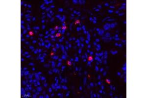 Immunofluorescence of paraffin embedded human lung cancer using TEAD3 (ABIN7075852) at dilution of 1: 700 (400x lens) (TEAD3 抗体)
