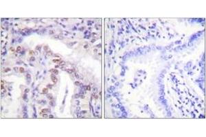 Immunohistochemistry analysis of paraffin-embedded human lung carcinoma, using SENP6 Antibody. (SENP6 抗体  (AA 1042-1091))