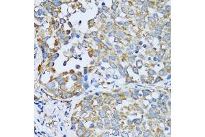 Immunohistochemistry of paraffin-embedded human lung cancer using RARS antibody. (RARS 抗体)