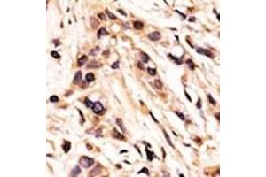 Formalin-fixed and paraffin-embedded human cancer tissue reacted with the primary antibody, which was peroxidase-conjugated to the secondary antibody, followed by AEC staining. (Retinoblastoma 1 抗体  (pSer608))