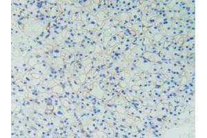 IHC-P analysis of Human Kidney Cancer Tissue, with DAB staining. (PODXL 抗体  (AA 220-431))