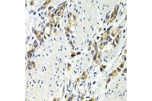 Immunohistochemistry of paraffin-embedded human stomach cancer using WNT3A antibody at dilution of 1:200 (400x lens). (WNT3A 抗体)