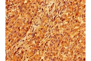Immunohistochemistry of paraffin-embedded human colon cancer using ABIN7146306 at dilution of 1:100 (ORAI1 抗体  (AA 1-87))