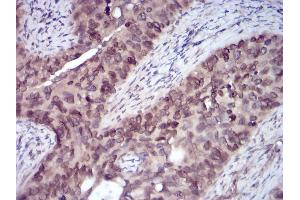 Immunohistochemical analysis of paraffin-embedded cervical cancer tissues using ERBB4 mouse mAb with DAB staining. (ERBB4 抗体  (AA 1159-1308))