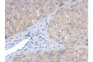 IHC-P Image Immunohistochemical analysis of paraffin-embedded human hepatoma, using Creatine kinase (brain) antibody, antibody at 1:500 dilution. (CKB 抗体)