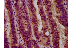 IHC image of ABIN7153944 diluted at 1:600 and staining in paraffin-embedded human colon cancer performed on a Leica BondTM system. (GBA 抗体  (AA 215-343))