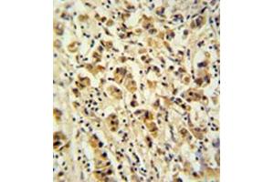 Formalin fixed and paraffin embedded human breast carcinoma reacted with DDX49 Antibody (C-term) followed by peroxidase conjugation of the secondary antibody and DAB staining.