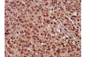 IHC image of ABIN7159657 diluted at 1:300 and staining in paraffin-embedded human glioma performed on a Leica BondTM system. (MMADHC 抗体  (AA 26-142))