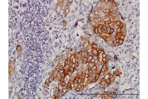 Immunoperoxidase of monoclonal antibody to EIF4G3 on formalin-fixed paraffin-embedded human lung, adenosquamous cell carcinoma. (EIF4G3 抗体  (AA 1-515))