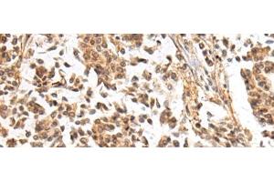 Immunohistochemistry of paraffin-embedded Human breast cancer tissue using NHLRC2 Polyclonal Antibody at dilution of 1:40(x200) (NHLRC2 抗体)