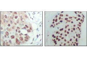 Immunohistochemical analysis of paraffin-embedded human esophagus cancer (left) and breast carcinoma tissue (right), showing nuclear localization with DAB staining using HDAC3 antibody. (HDAC3 抗体  (AA 224-428))