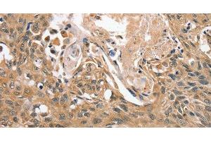 Immunohistochemistry of paraffin-embedded Human esophagus cancer tissue using RBM38 Polyclonal Antibody at dilution 1:45 (RBM38 抗体)