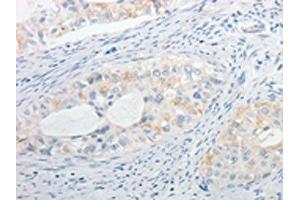 The image on the left is immunohistochemistry of paraffin-embedded Human cervical cancer tissue using ABIN7130256(MPZ Antibody) at dilution 1/15, on the right is treated with fusion protein. (MPZ 抗体)