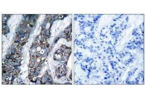 Immunohistochemical analysis of paraffin-embedded human breast carcinoma tissue using HER2 (phospho-Tyr1248) antibody (E011079). (ErbB2/Her2 抗体  (pTyr1248))