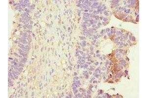 Immunohistochemistry of paraffin-embedded human ovarian cancer using ABIN7167394 at dilution of 1:100 (RALB 抗体  (AA 1-206))