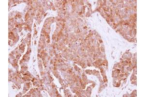 IHC-P Image Immunohistochemical analysis of paraffin-embedded human adenocarcinoma, using HPRT, antibody at 1:500 dilution. (HPRT1 抗体)