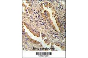 Formalin-fixed and paraffin-embedded human lung carcinoma reacated with IL8 antibody which was peroxidase-conjugated to the secondary antibody, followed by DAB staining. (IL-8 抗体  (C-Term))
