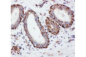 IHC-P: MTCO1 antibody testing of human breast cancer tissue (COX1 抗体  (C-Term))