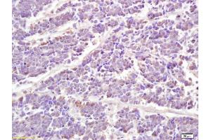 Formalin-fixed and paraffin embedded human lung carcinoma labeled with Anti phospho-STAT1 (Ser727) Polyclonal Antibody, Unconjugated (ABIN746168) at 1:200 followed by conjugation to the secondary antibody and DAB staining