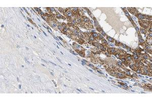 ABIN6269219 at 1/100 staining Human liver cancer tissue by IHC-P. (Cadherin 5 抗体  (C-Term))