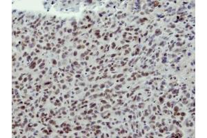 IHC-P Image Immunohistochemical analysis of paraffin-embedded HS578T xenograft, using CLP1, antibody at 1:100 dilution.