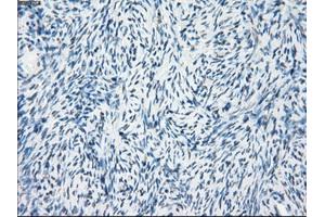Immunohistochemical staining of paraffin-embedded Adenocarcinoma of breast tissue using anti-FOSL1 mouse monoclonal antibody. (FOSL1 抗体)