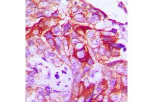 Immunohistochemical analysis of RET (pY1062) staining in human breast cancer formalin fixed paraffin embedded tissue section. (Ret Proto-Oncogene 抗体  (C-Term, pTyr1062))
