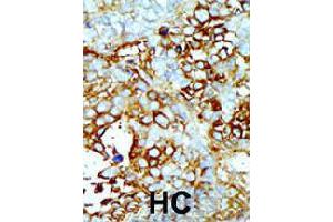 Formalin-fixed and paraffin-embedded human hepatocellular carcinoma tissue reacted with MAP4K2 polyclonal antibody  , which was peroxidase-conjugated to the secondary antibody, followed by AEC staining . (MAP4K2 抗体  (Internal Region))