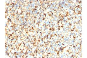 Formalin-fixed, paraffin-embedded human Melanoma stained with CD63-Monospecific Recombinant Mouse Monoclonal Antibody (rMX-49. (Recombinant CD63 抗体)