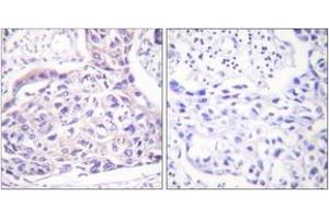 Immunohistochemistry analysis of paraffin-embedded human breast carcinoma, using IRS-1 (Phospho-Ser323) Antibody. (IRS1 抗体  (pSer323))
