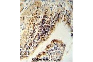 CHEK2 Antibody (N-term) (ABIN1881196 and ABIN2840120) IHC analysis in formalin fixed and paraffin embedded colon carcinoma followed by peroxidase conjugation of the secondary antibody and DAB staining.