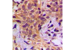 Immunohistochemical analysis of HSP90 beta (pS254) staining in human breast cancer formalin fixed paraffin embedded tissue section. (HSP90AB1 抗体  (pSer254))