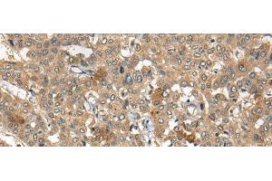 Immunohistochemistry of paraffin-embedded Human liver cancer tissue using ARCN1 Polyclonal Antibody at dilution of 1:50(x200) (ARCN1 抗体)