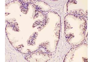 GAA was detected in paraffin-embedded sections of human prostatic cancer tissues using rabbit anti- GAA Antigen Affinity purified polyclonal antibody (Catalog # ) at 1 µg/mL. (GAA 抗体  (Middle Region))